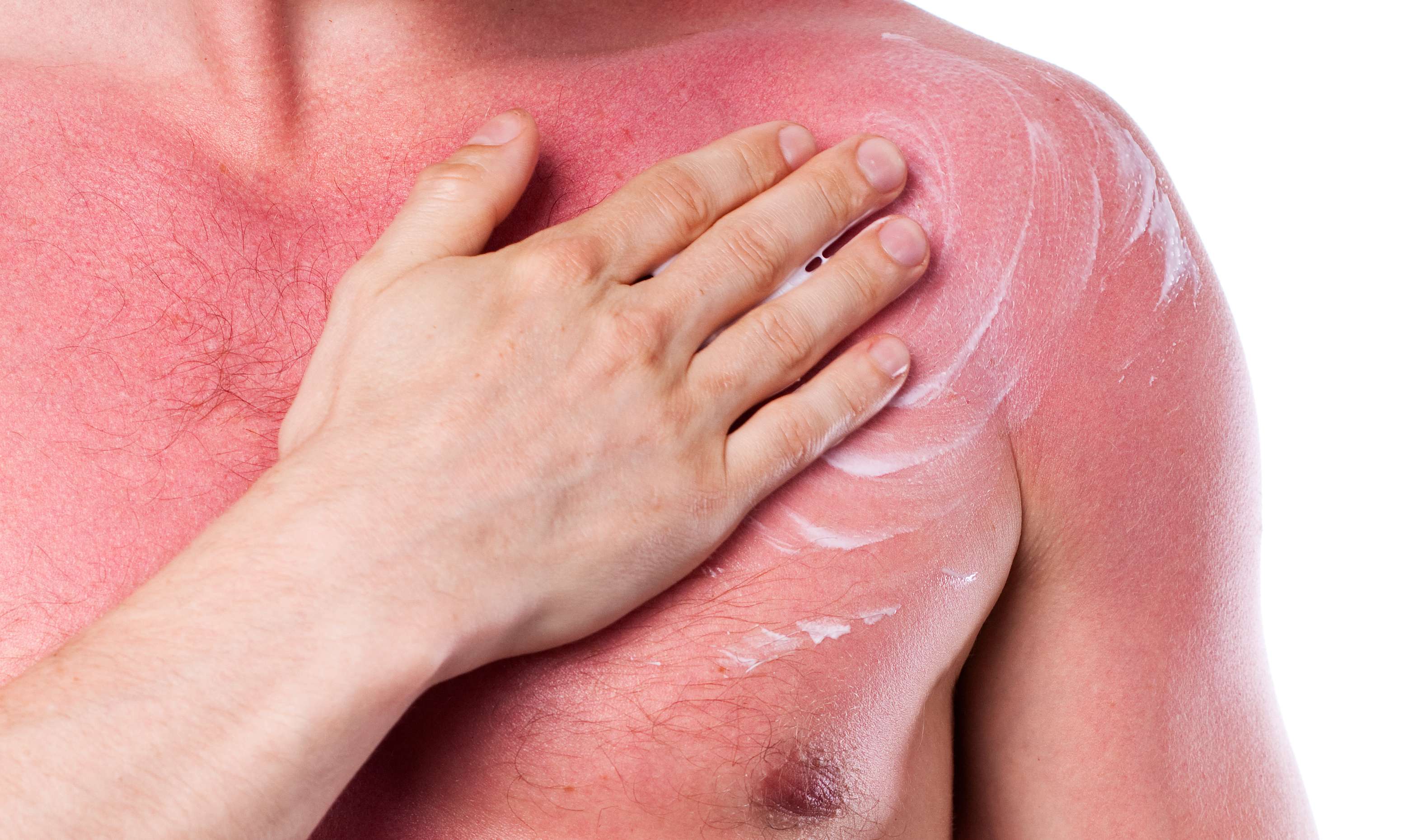 Allianz Gesundheitswelt - Solarium: ein Mann cremt sich seinen starken Sonnenbrand am Oberkörper ein.