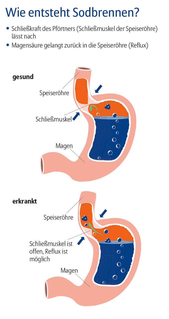 Die Grafik trägt den Titel „Wie entsteht Sodbrennen?“ und besteht aus zwei farbigen Darstellungen des oberen Verdauungstrakts – jeweils ein Querschnitt durch Speiseröhre und Magen. Oben ist eine gesunde Situation zu sehen. Die Speiseröhre führt in den Magen. Ein deutlich eingezeichneter Schließmuskel befindet sich an der Verbindung beider Organe. Im Magen ist blaue Flüssigkeit mit Gasblasen dargestellt, die durch den geschlossenen Schließmuskel nicht zurück in die Speiseröhre gelangen kann. Der Bereich der Speiseröhre ist farblich orange markiert. Darunter ist die Darstellung einer erkrankten Situation. Auch hier sind Speiseröhre und Magen abgebildet, aber der Schließmuskel ist geöffnet. Die blaue Flüssigkeit mit Gasblasen steigt aus dem Magen in die orange dargestellte Speiseröhre auf. Ein grüner Pfeil zeigt die Rückflussrichtung der Magensäure. Neben den Abbildungen befinden sich erklärende Texte: „Schließkraft des Pförtners (Schließmuskel der Speiseröhre) lässt nach“ „Magensäure gelangt zurück in die Speiseröhre (Reflux)“ „Schließmuskel ist offen, Reflux ist möglich“