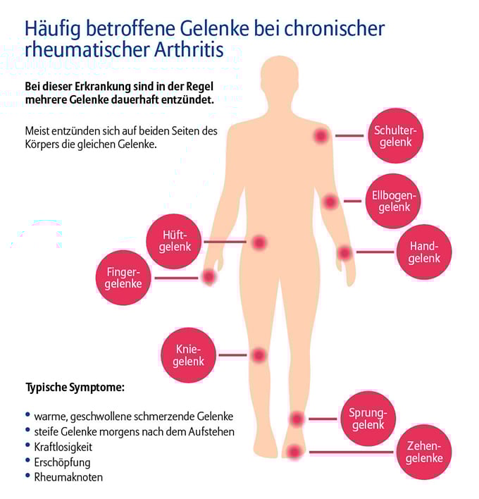 Die Grafik trägt den Titel „Häufig betroffene Gelenke bei chronischer rheumatischer Arthritis“. Darunter steht der Hinweis, dass bei dieser Erkrankung in der Regel mehrere Gelenke dauerhaft entzündet sind und meist symmetrisch – also auf beiden Körperseiten – dieselben Gelenke betroffen sind. Im Zentrum der Grafik ist eine stilisierte menschliche Figur dargestellt. An verschiedenen Stellen des Körpers sind rot markierte Kreise mit Bezeichnungen angebracht, die die häufig betroffenen Gelenke anzeigen: Am Kopf bzw. oberen Körperbereich sind das Schul­tergelenk und Ellbogengelenk hervorgehoben. An den Armen folgen Handgelenk und Fingergelenke. Seitlich ist das Hüftgelenk markiert. Am unteren Körper sind Kniegelenk, Sprunggelenk und Zehengelenke rot gekennzeichnet. Unter der Körperdarstellung ist ein Abschnitt mit der Überschrift „Typische Symptome“. Genannt werden: warme, geschwollene, schmerzende Gelenke; steife Gelenke morgens nach dem Aufstehen; Kraftlosigkeit; Erschöpfung und Rheumaknoten.