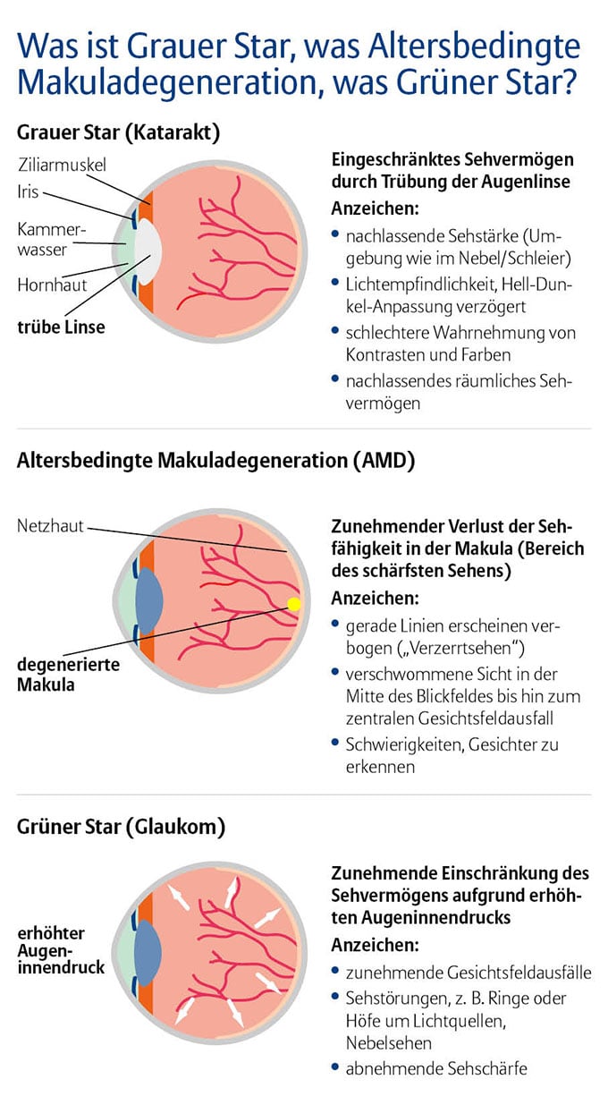 Die Infografik trägt den Titel „Was ist Grauer Star, was Altersbedingte Makuladegeneration, was Grüner Star?“ und stellt drei verschiedene Augenkrankheiten in separaten Abschnitten mit erklärenden Illustrationen und Texten dar. Oben wird der Graue Star (Katarakt) erklärt. Die dazugehörige Illustration zeigt einen Querschnitt durch das Auge mit einer getrübten Linse. Beschriftet sind Ziliarmuskel, Iris, Kammerwasser, Hornhaut und die „trübe Linse“.  Im Text daneben steht, dass das Sehvermögen durch eine Trübung der Augenlinse eingeschränkt ist. Anzeichen sind: nachlassende Sehstärke mit dem Gefühl, wie durch Nebel oder Schleier zu sehen, Lichtempfindlichkeit, verzögerte Anpassung an Hell-Dunkel-Wechsel, schlechtere Wahrnehmung von Kontrasten und Farben sowie ein nachlassendes räumliches Sehvermögen. In der Mitte wird die Altersbedingte Makuladegeneration (AMD) dargestellt. Die Illustration zeigt ein Auge mit einer geschädigten Netzhaut und einer markierten „degenerierten Makula“.  Laut Text kommt es zum zunehmenden Verlust der Sehfähigkeit im Bereich der Makula – also dort, wo das schärfste Sehen möglich ist. Anzeichen sind: gerade Linien erscheinen verzerrt, verschwommenes Sehen in der Mitte des Gesichtsfeldes bis hin zum zentralen Gesichtsfeldausfall und Schwierigkeiten, Gesichter zu erkennen. Unten folgt der Grüne Star (Glaukom). Die Grafik zeigt ein Auge mit angedeutetem erhöhtem Augeninnendruck.  Im Text wird erklärt, dass das Sehvermögen zunehmend durch den Druck im Auge eingeschränkt wird. Typische Anzeichen sind: zunehmende Gesichtsfeldausfälle, Sehstörungen wie Ringe oder Höfe um Lichtquellen sowie Nebel- oder Schleiersehen und eine abnehmende Sehschärfe.  